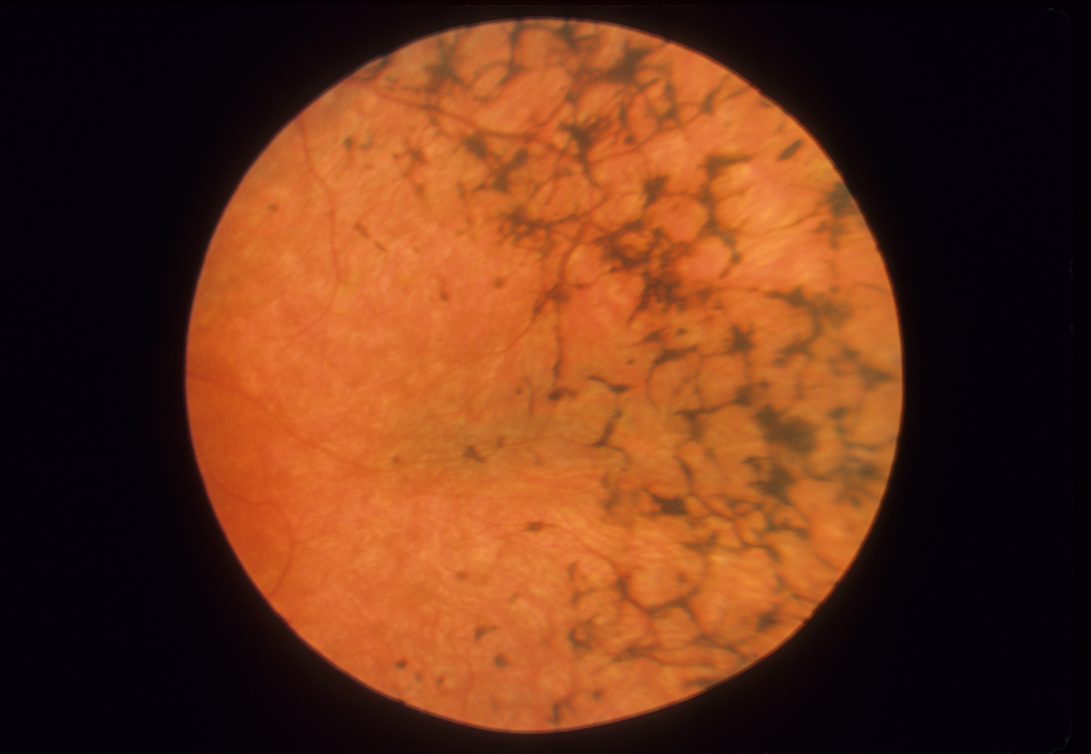 Retinitis Pigmentosa, AR Hereditary Ocular Diseases